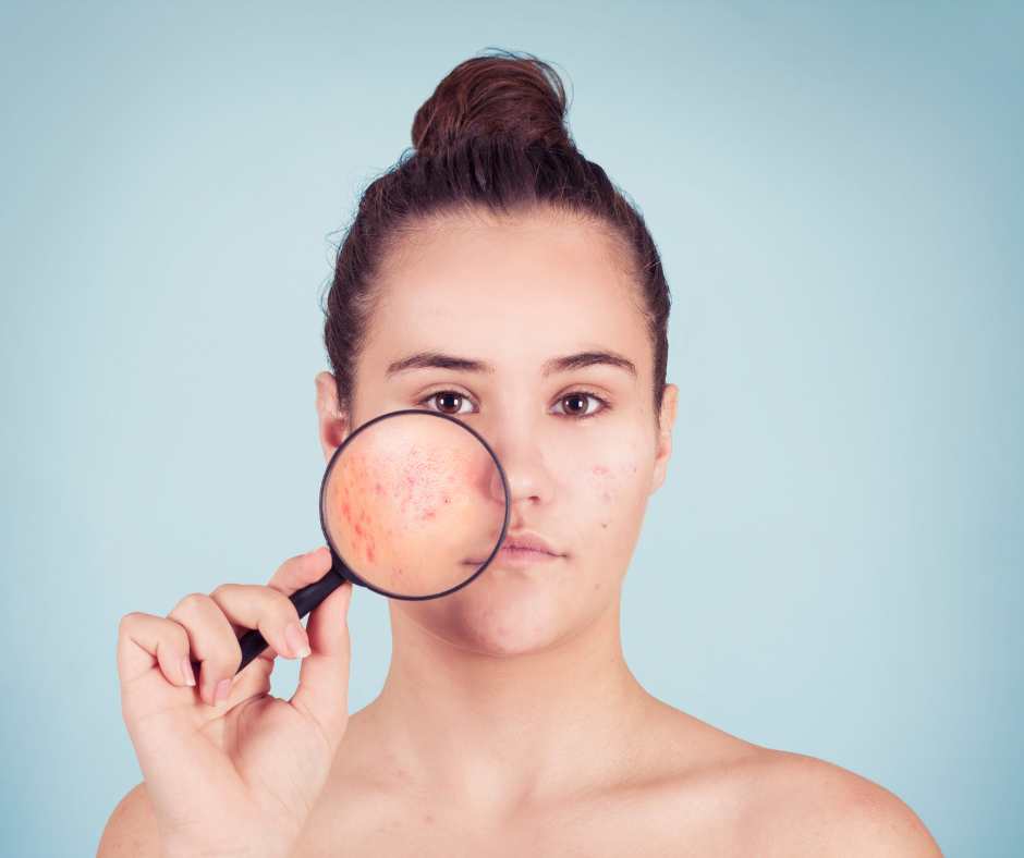 Alimentazione Ormonale e acne